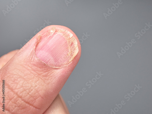 Brittle fingernail of a 9 year old boy close up look, isolated on gray background, with copy space