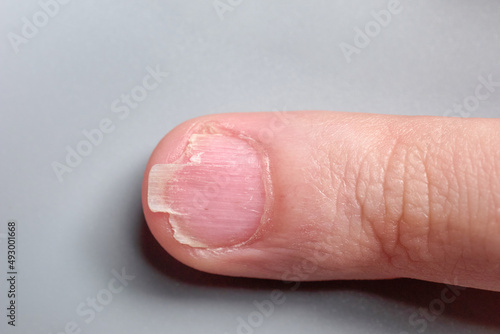 Brittle fingernail of a 9 year old boy close up look, isolated on gray background