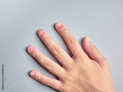 Hand of a 9 year old boy with brittle nails isolated on gray background, nails disease