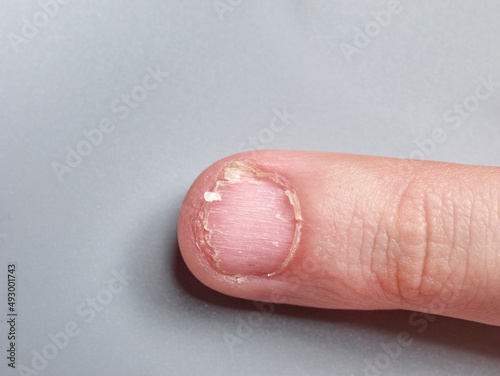 Fingernail of a 9 year old boy with a nail disease, very weak or brittle nails, isolated on gray background