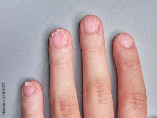 Hand of a young boy with brittle or very weak nails, isolated on gray background, no faces shown