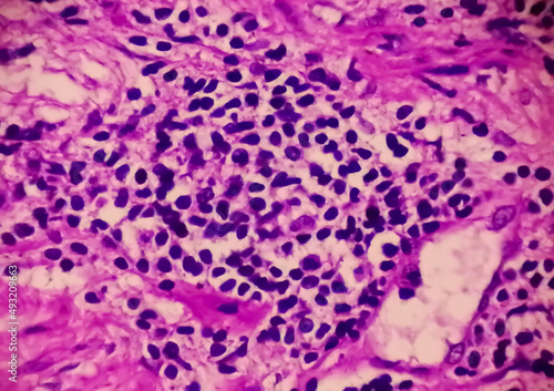 Prostate Cancer (TURP): Microscopic image of prostatic tissue, adenocarcinoma, malignant neoplasm, atypical epithelial cells, malignant tumor. transurethral resection of the prostate.