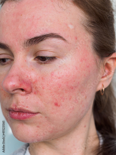 exacerbation of rosacea on the patient's face due to stress