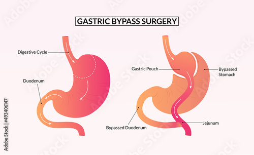 Gastric bypass surgery before and after medical illustration.