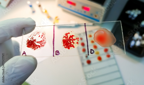 AB negative rare Blood group testing by slide agglutination