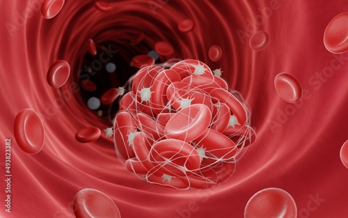 Blood clot illustration, Thrombosis is a dangerouse disease which can lead to a stroke or heart attack