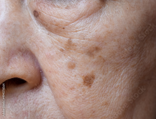 Small brown patches called age spots on face of Asian elder woman. They are also called liver spots, senile lentigo, or sun spots.