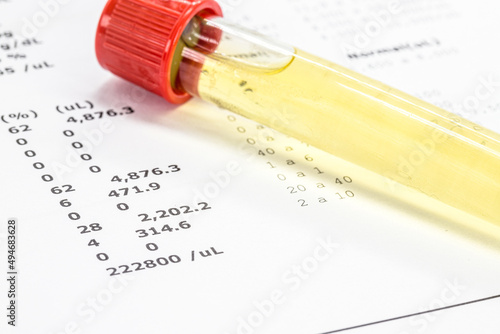 urine vial in laboratory, toxicology or routine examination