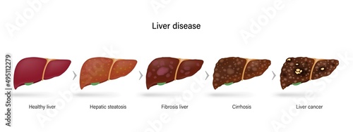 Liver disease. Stages of liver damage. Healthy liver, hepatic steatosis , fibrosis, cirrhosis and liver cancer.
