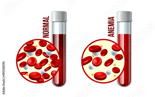 Iron deficiency anemia.The difference of Anemia amount of red blood cell and normal.