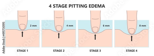 meige syndrome edema Milroy Leg venous Deep vein cancer swelling upper limb wrap calf ulcer lymph node arms hand pain cloth blood feet ankle liver kidney heart lung non Nonpitting pedal