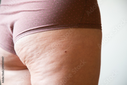 cellulite or orange crust on feet. Reducing overweight and struggle with cellulite, subcutaneous fat deposition