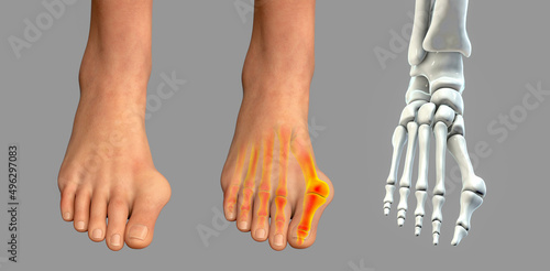 Toe deformation, also known as hallux valgus, or bunion