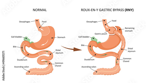 Roux-en-y gastric bypass (RNY). Showing a gastric pouch and gastrojejunal anastomosis.