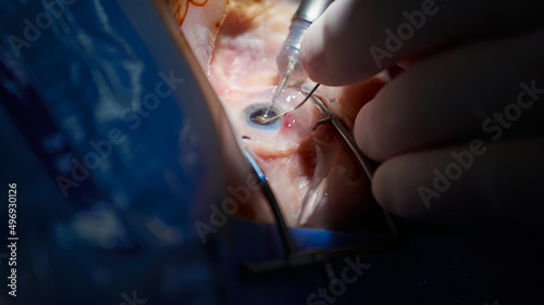 Operacja zaćmy, katarakta, zbliżenie operowanej gałki ocznej, sala operacyjna, blok operacyjny