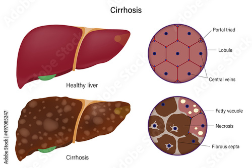 Liver histology. Normal liver and cirrhosis liver. Liver disease for medical education and science.