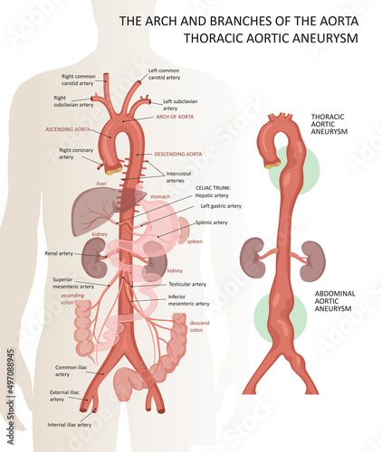 The arch and branches of the aorta. Thoracic aortic aneurysm