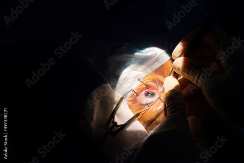 Close-up of a human eye, cataract surgery in an ophthalmology operating room.