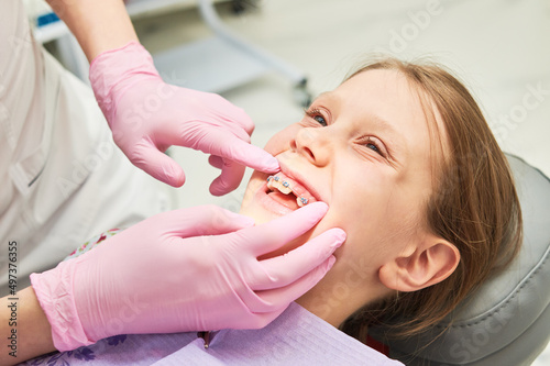 Braces for child teeth correction. Installation and maintenace