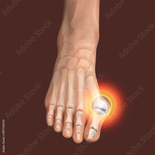 Toe deformation, also known as hallux valgus, or bunion