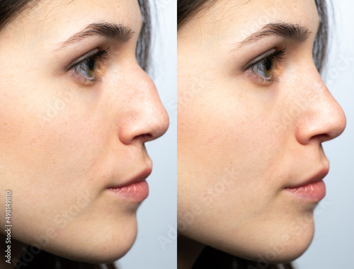 Nose before and after nasal filler surgery