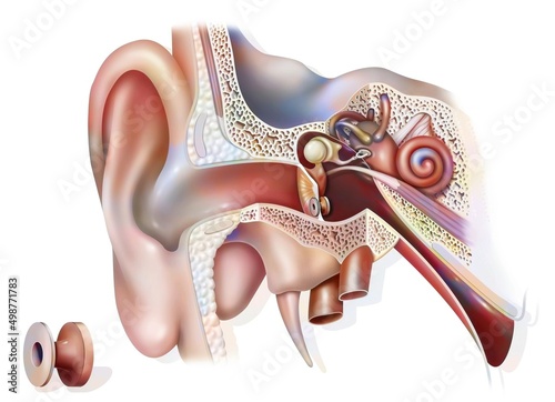 Otitis treatment: tympanic ventilator in the ear to promote.