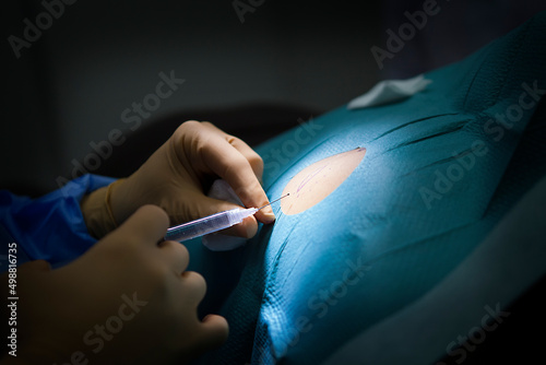 Anesthesia for removal of a cyst in a dermatology practice.