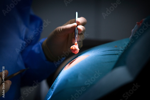 Removal of a cyst by the dermatologist.