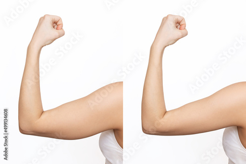 Two shots of a young woman with excess fat on her arm and toned arm before and after losing weight isolated on a white background. Result of diet, liposuction, training. Plastic surgery concept