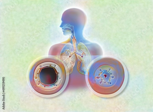 Comparison between healthy bronchi and bronchitis (acute bronchitis).