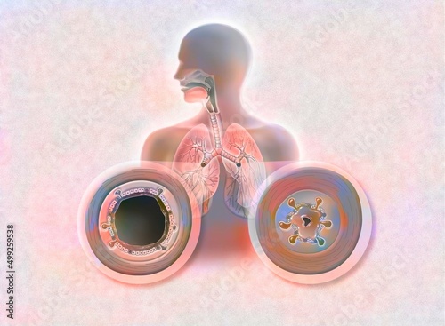 Comparison between healthy bronchi and bronchitis (acute bronchitis).