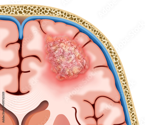Ilustración descriptiva de un tumor cerebral, esta masa o bulto de células anormales afectará el funcionamiento del sistema nervioso. 
