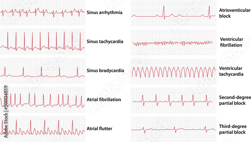 Schemes set of common electrocardiogram (ECG) abnormalities, including partial blocks and flutter