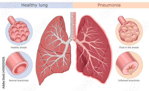 Pneumonia symptoms medical diagram. Healthy lung and lung with pneumonia.