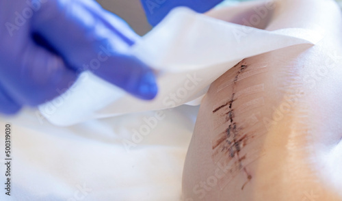 The doctor applies a patch to the scar after surgery on the child's leg. Antibacterial patch.