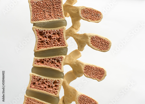 Model of the human spine on a white background, which shows various defects in bones and vertebrae. From top to bottom: normal vertebral bone, osteoporotic bone, wedge fracture, compression fracture.