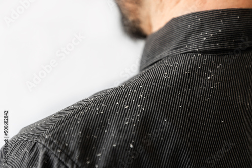 A bearded man in a black shirt, a close up view of the shoulder covered with dandruff. Copy space. The concept of psoriasis and seborrheic dermatitis