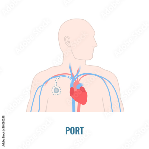 Implantable venous access port. Under the skin central line access device for chemotherapy infusion, medication administration and blood drawing. Medical vector illustration.
