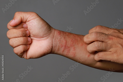 Close up allergic rash dermatitis eczema skin of patient wrist.