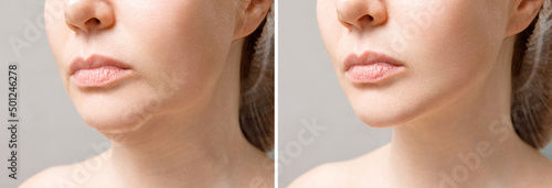 Female double chin before and after correction. Correction of the chin shape liposuction of the neck. The result of the procedure in the clinic of aesthetic medicine.