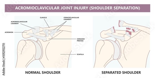 Separation dislocation the AC joint fall shoulder bump bruise torn cuff tear nerve bone broken Trauma pain arc arm sport medicine Neer FOOSH test Grade X ray Brace arthroscopy recovery range of motion