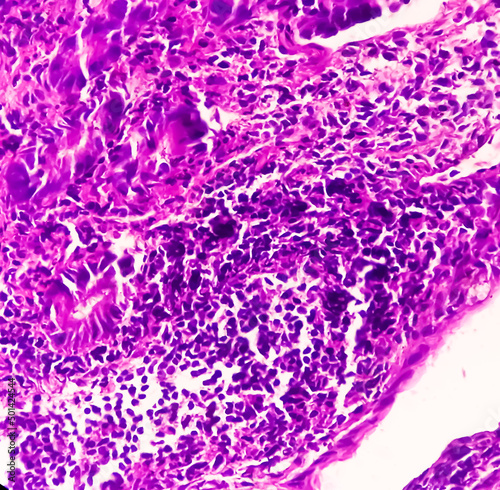 Tissue from terminal ileum: Chronic nonspecific ileitis or inflammation of the ileum, is often caused by Crohn's disease. inflammatory bowel disease (IBD).