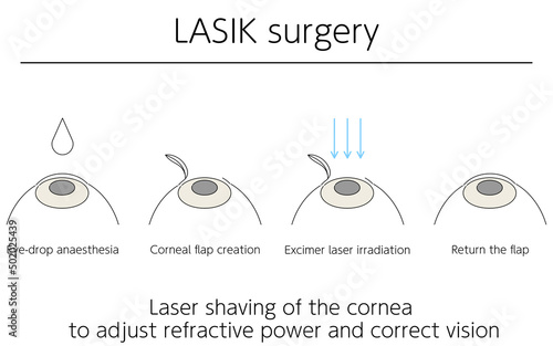 図解、レーシックによる視力矯正、メディカルイラスト