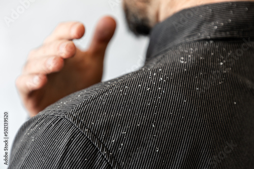 A bearded man in a black shirt shakes dandruff of his shoulder. Close-up. The concept of psoriasis and seborrheic dermatitis