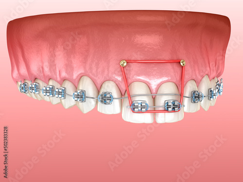 Elastics and metal braces for correction overbite of frontal incisors. Dental 3D illustration