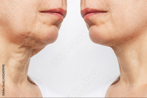 Lower part of face and neck of elderly woman with signs of skin aging before and after facelift, plastic surgery isolated on white background. Age-related changes, flabby sagging skin. Platysmoplasty