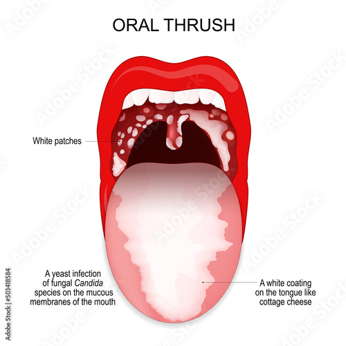 Oral thrush. A white coating on the tongue and White patches in throat.