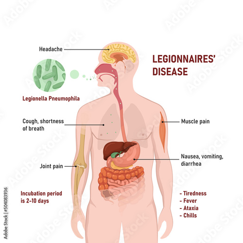 Legionnaires disease or legionellosis or Legion fever. Signs and symptoms is a form of atypical pneumonia.