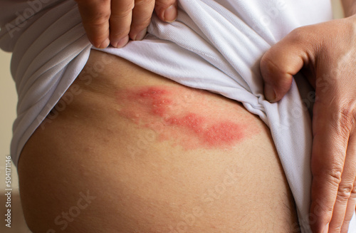 Shingles (herpes zoster) blister skin rash