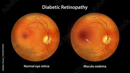 Proliferative diabetic retinopathy, illustration